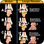 Pete had a weber B fracture